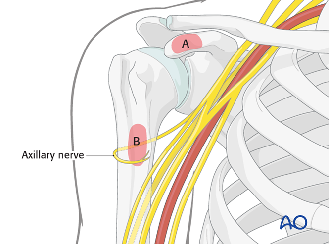 Deltopectoral approach to the proximal humerus