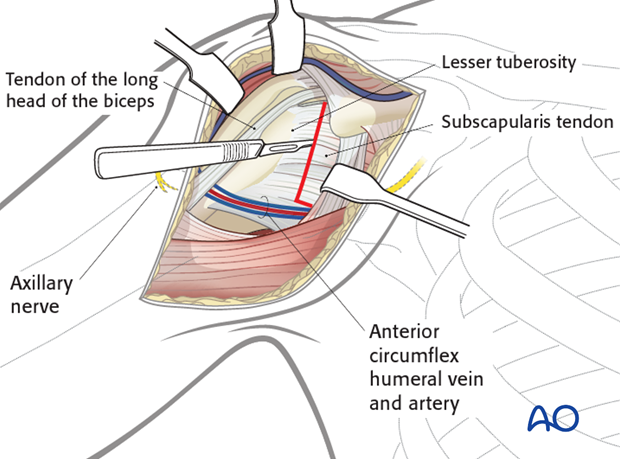 deltopectoral approach to the proximal humerus