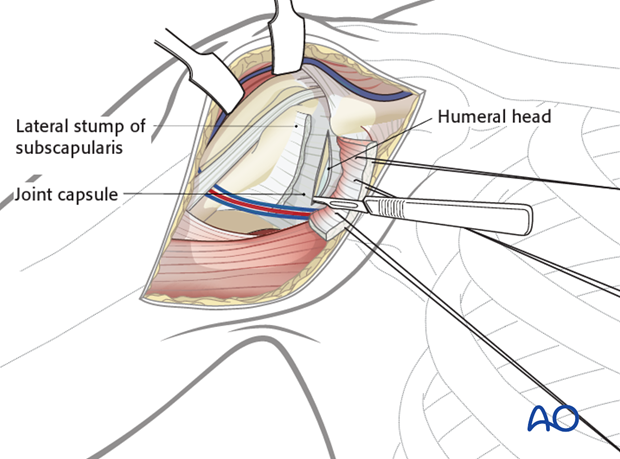 deltopectoral approach to the proximal humerus