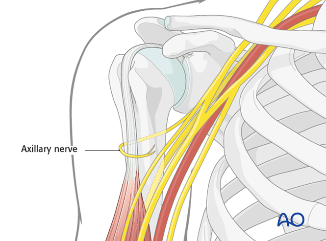 Anterolateral approach to the proximal humerus