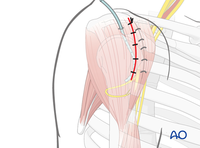 Anterolateral approach to the proximal humerus