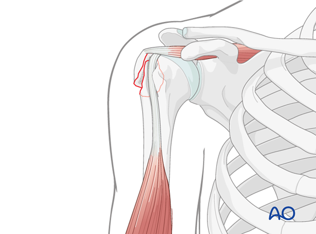 greater tubercle of humerus