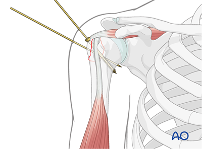 MIO - Screw fixation for Extraarticular 2-part, greater tuberosity ...