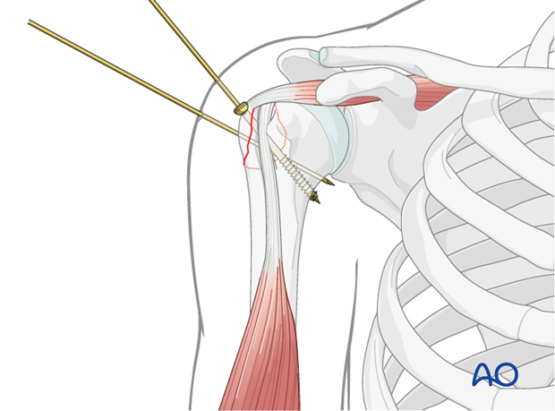 11_C10_A12A13_i200 It is the surgeons preference whether to use 3.5 mm cannulated lag screws or small fragment screws.