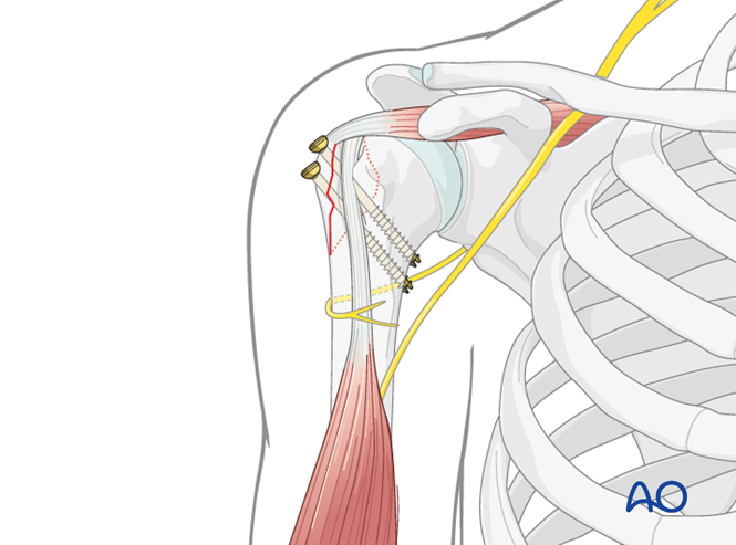 MIO - Screw fixation for Extraarticular 2-part, greater tuberosity ...