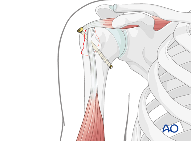 11_C10_A12A13_i220 Once osteosynthesis is completed remove all K-wires. Check fixation by image intensification.