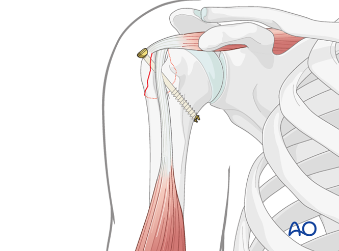 MIO - Screw fixation for Extraarticular 2-part, greater tuberosity ...