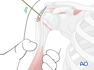 Mio - Plate Fixation For Extraarticular 2-part, Surgical Neck, Impaction