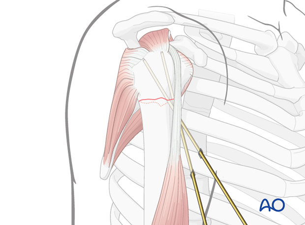 The reduction of the humeral head is temporarily secured using 2 to 3 K-wires.