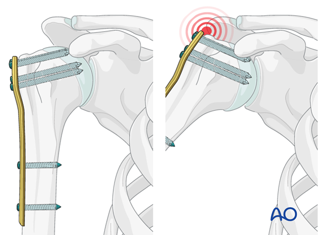 Pitfall: plate too proximal