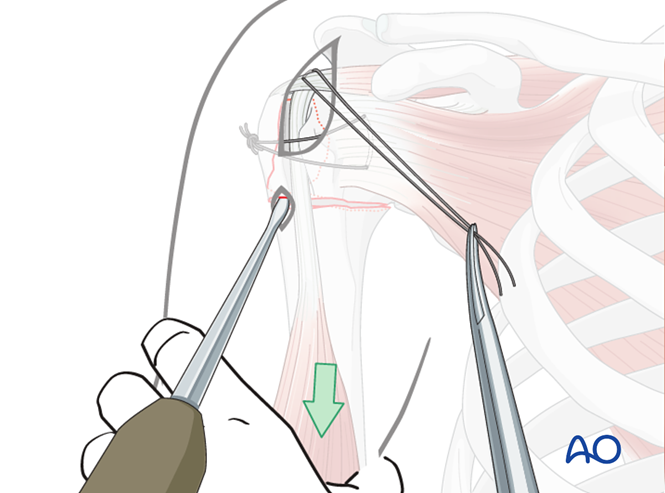 MIO - Plate fixation for Extraarticular 3-part, surgical neck and ...