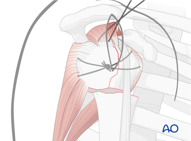 MIO - Plate fixation for Extraarticular 3-part, surgical neck and ...