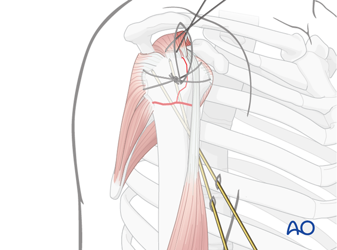 MIO - Plate fixation for Extraarticular 3-part, surgical neck and ...