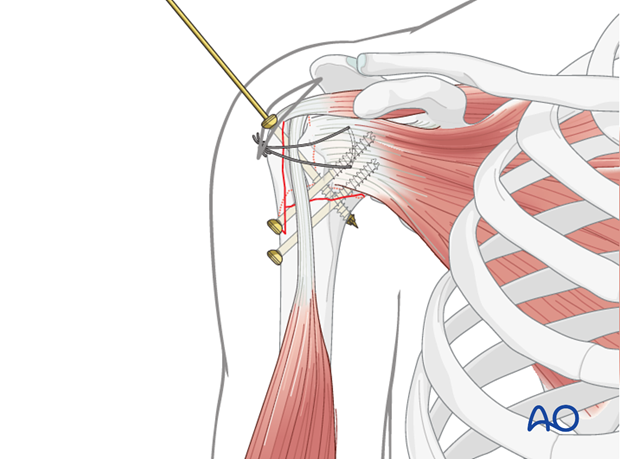 Screw insertion into humeral head