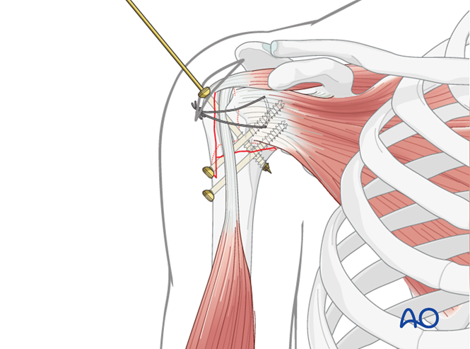 MIO - Screw fixation for Extraarticular 3-part, surgical neck and ...