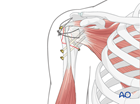 extraarticular 3 part surgical neck and tuberosity dislocation