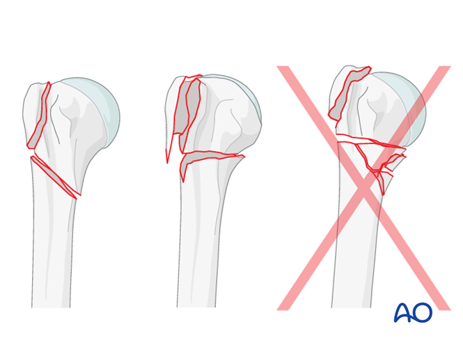 MIO - Screw fixation for Extraarticular 3-part, surgical neck and ...
