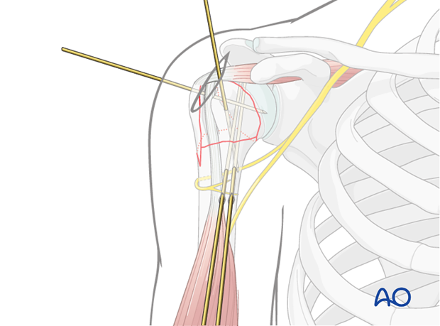 Temporary fixation using K-wires