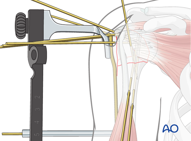 Attaching the plate to humerus