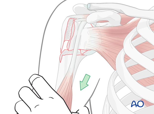 As a first step perform a closed reduction taking advantage of the intact soft-tissue sleeve.