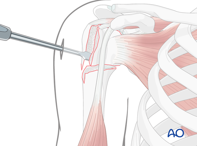 MIO - Plate fixation for 4-Part, slight displacement, varus malalignment