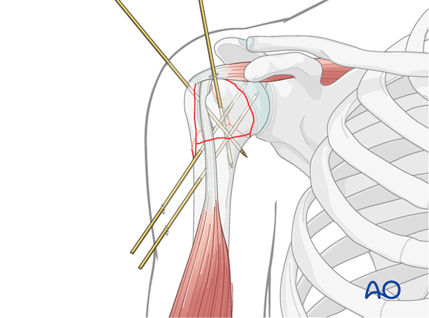 Temporarily fix the fracture with K-wires as illustrated in this case for a 4-part fracture. 