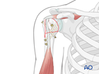 isolated anatomical neck slight displacement