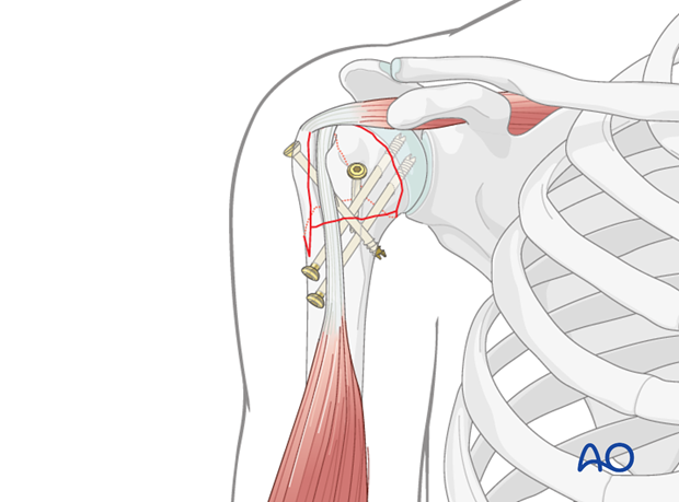 Check the reduction and the length/position oft the screws by image intensification. 