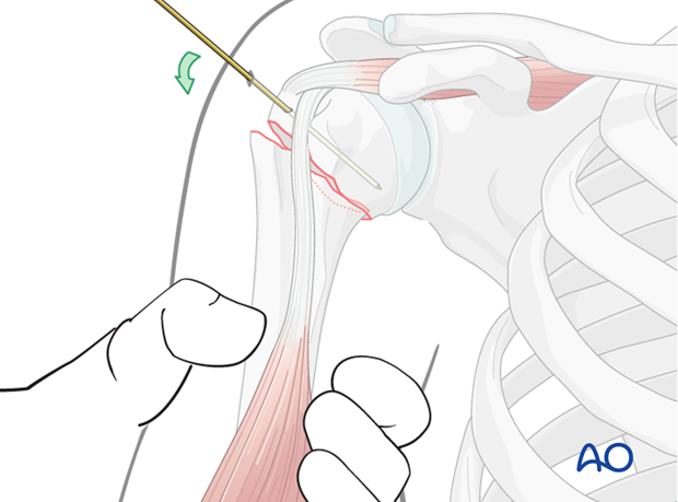 Threaded pins or K-wires may be inserted into the proximal fragment and used as joy sticks for fracture reduction.