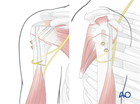 extraarticular 2 part surgical neck impaction