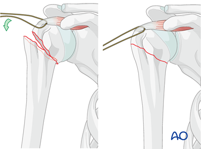 Nailing (straight nail) for Extraarticular 2-part, surgical neck, impaction