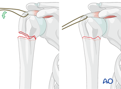 Nailing (bent nail) for Extraarticular 2-part, surgical neck, no impaction