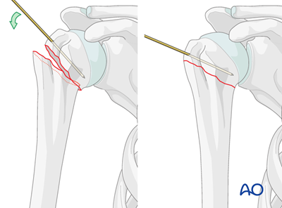 Nailing (straight nail) for Extraarticular 2-part, surgical neck, impaction