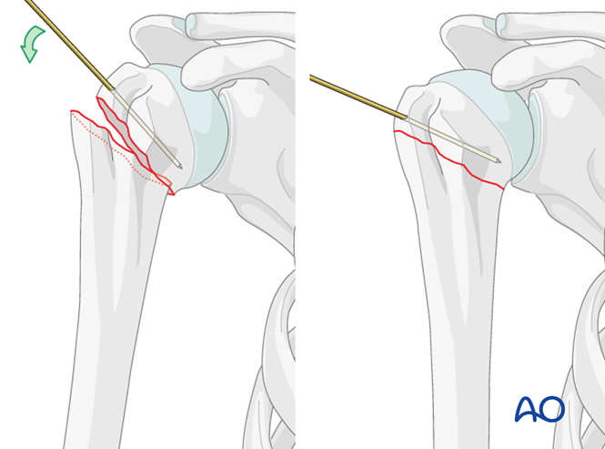 Nailing (straight nail) for Extraarticular 2-part, surgical neck, impaction