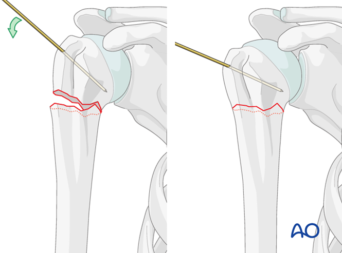 Nailing (bent nail) for Extraarticular 2-part, surgical neck, no impaction