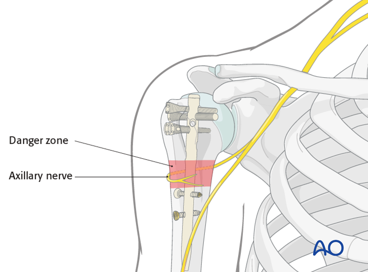 Discover more than 120 synthes humeral nail technique guide super hot