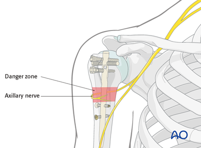 Nailing (straight nail) for Extraarticular 2-part, surgical neck, impaction