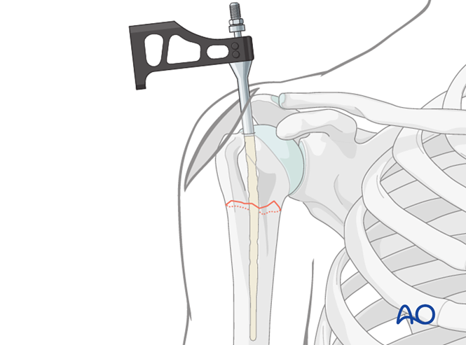 Nailing (bent nail) for Extraarticular 2-part, surgical neck, no impaction