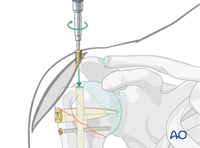 Nailing (bent nail) for Extraarticular 2-part, surgical neck, impaction