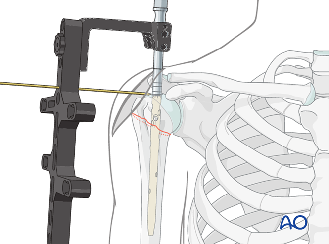 Nailing (straight nail) for Extraarticular 2-part, surgical neck, impaction