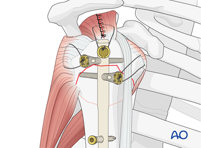 Nailing (straight nail) for Extraarticular 2-part, surgical neck, impaction