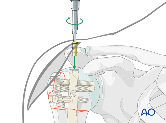 Nailing for Extraarticular 3-part, surgical neck and greater tuberosity ...