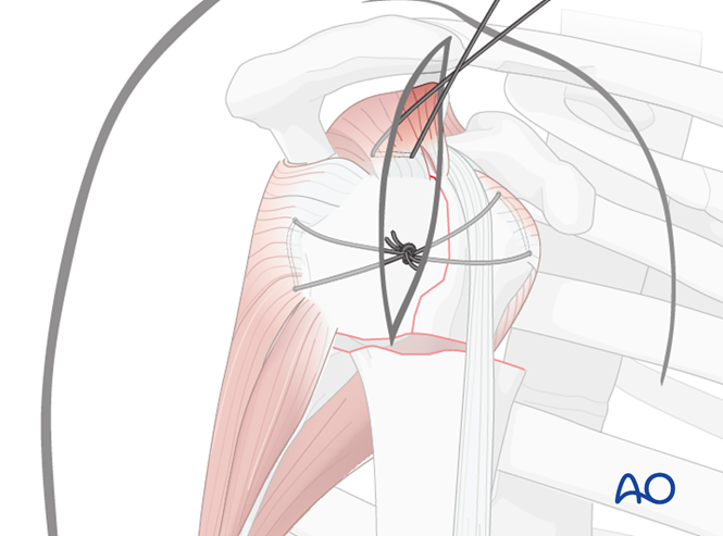 Nailing for Extraarticular 3-part, surgical neck and greater tuberosity ...