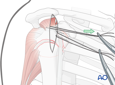 Nailing for Extraarticular 3-part, surgical neck and lesser tuberosity ...