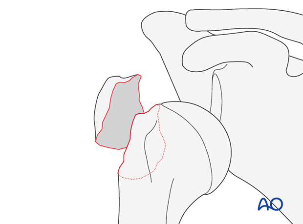 Fracture of tuberosity with glenohumeral dislocation