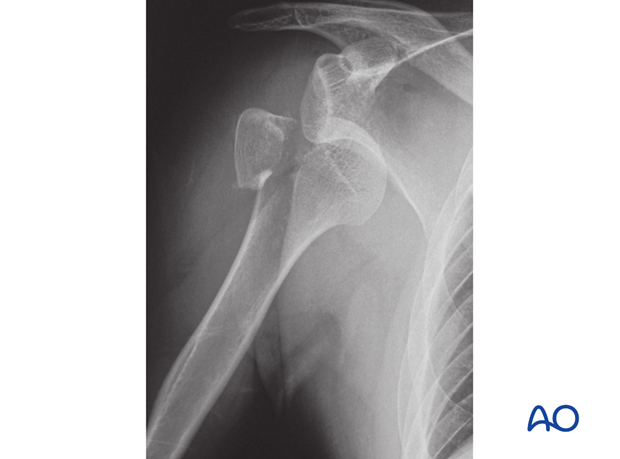 Fracture of tuberosity with glenohumeral dislocation