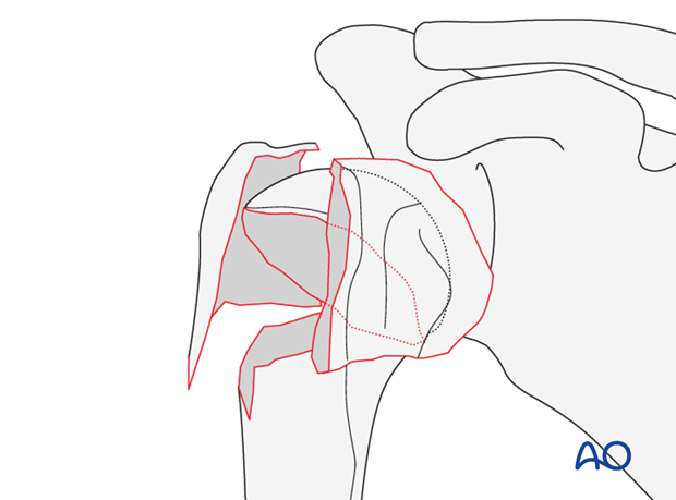 4-part fracture, slight displacement, intact articular surface, valgus malalignment