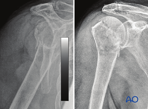 4-Part fracture with valgus malalignment