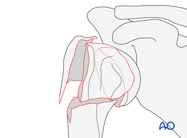 4-part fracture, slight displacement, intact articular surface, varus malalignment