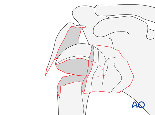 4-part fracture, marked displacement, intact articular surface, valgus malalignment